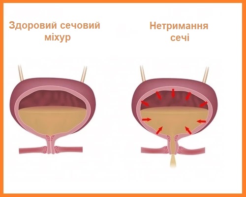 Чому виникають проблеми з сечовипусканням і коли звертатися до уролога?